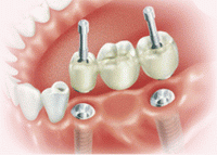 стоматология протезирование зубов